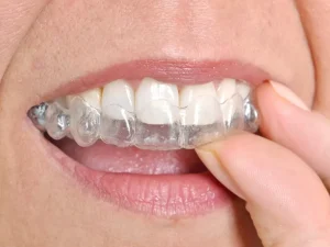 air gap invisalign