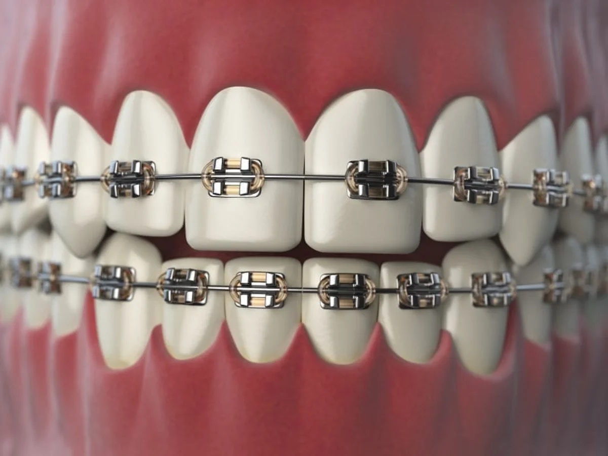 Dental Brace