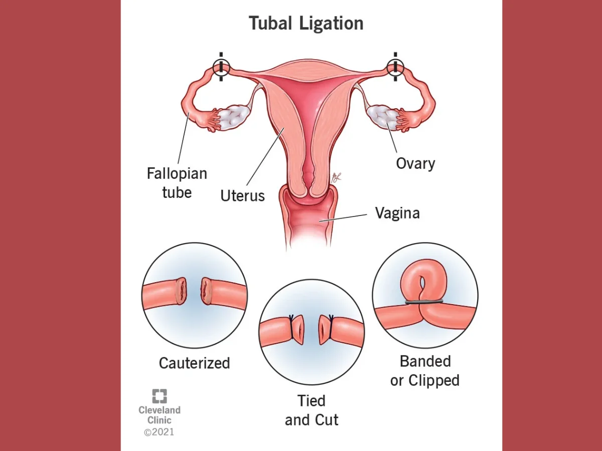 tubal ligation